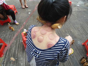cupping therapy massage