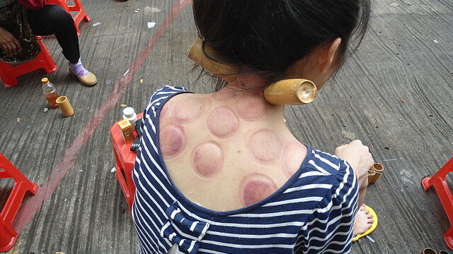 cupping therapy massage