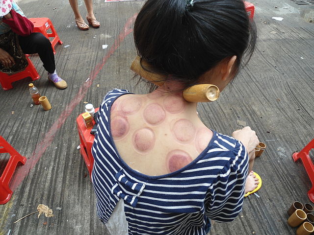 Have You Tried Cupping Therapy Massage Yet? | Hollywood Health Trends